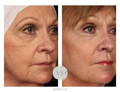 Kybella Before & After Gallery - Patient 257522 - Image 1