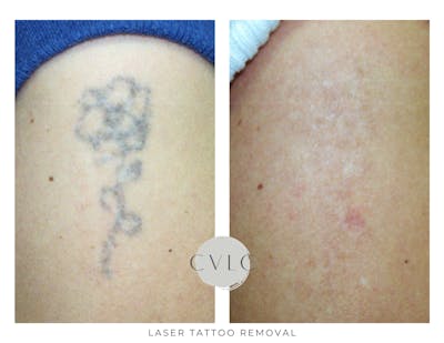 Laser Tattoo Removal Before & After Gallery - Patient 513020 - Image 1