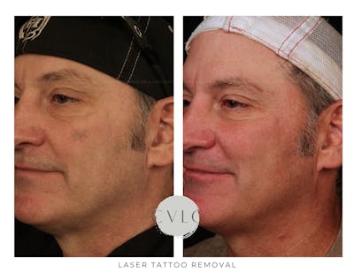 Laser Tattoo Removal Before & After Gallery - Patient 689418 - Image 1