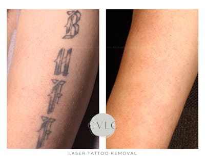 Laser Tattoo Removal Before & After Gallery - Patient 358334 - Image 1