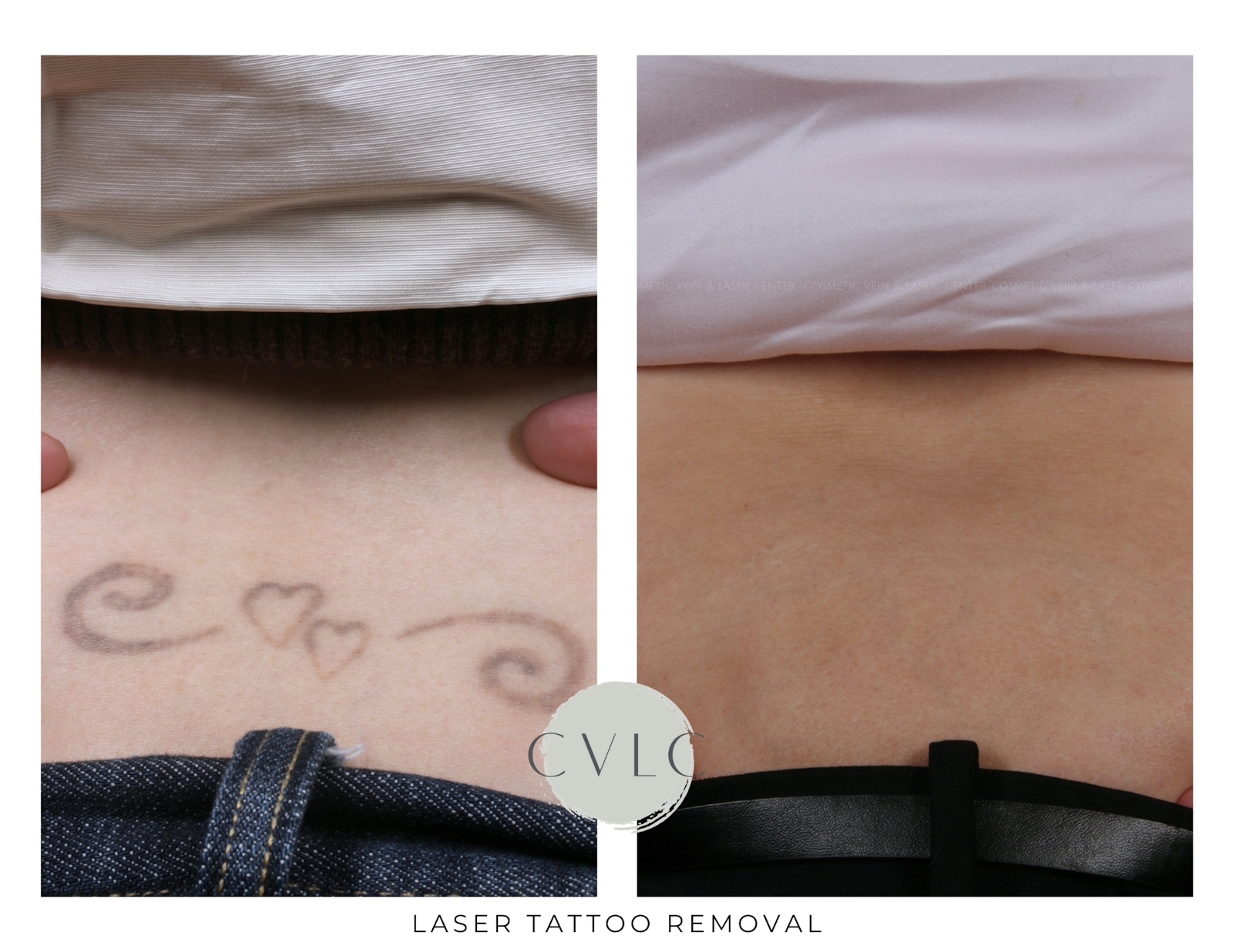 Laser Tattoo Removal Before & After Gallery - Patient 998269 - Image 1