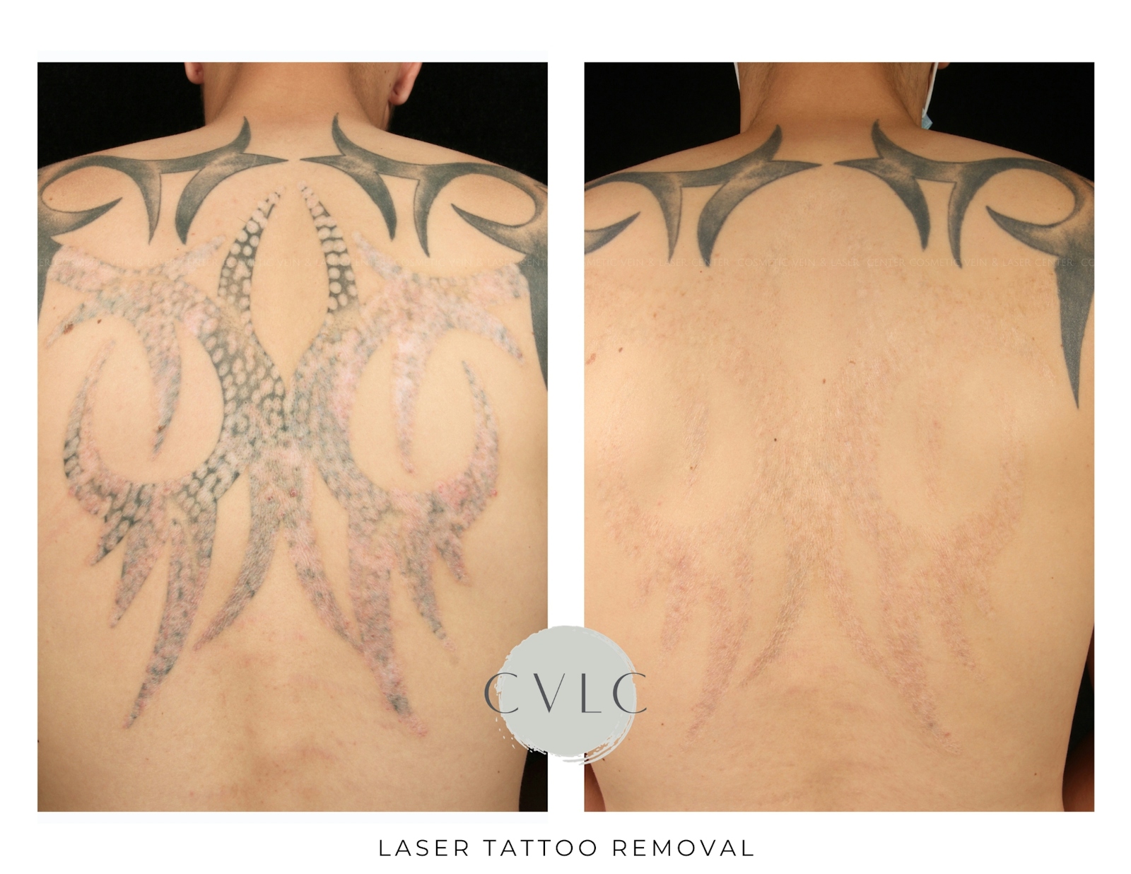 Laser Tattoo Removal Before & After Gallery - Patient 263080 - Image 1
