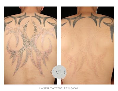 Laser Tattoo Removal Before & After Gallery - Patient 263080 - Image 1