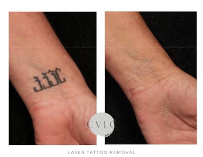 Laser Tattoo Removal Before & After Gallery - Patient 162201 - Image 1