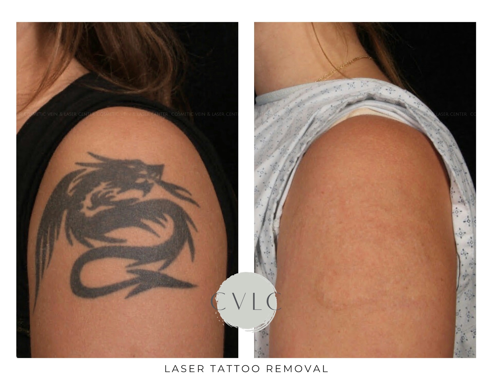 Laser Tattoo Removal Before & After Gallery - Patient 259749 - Image 1