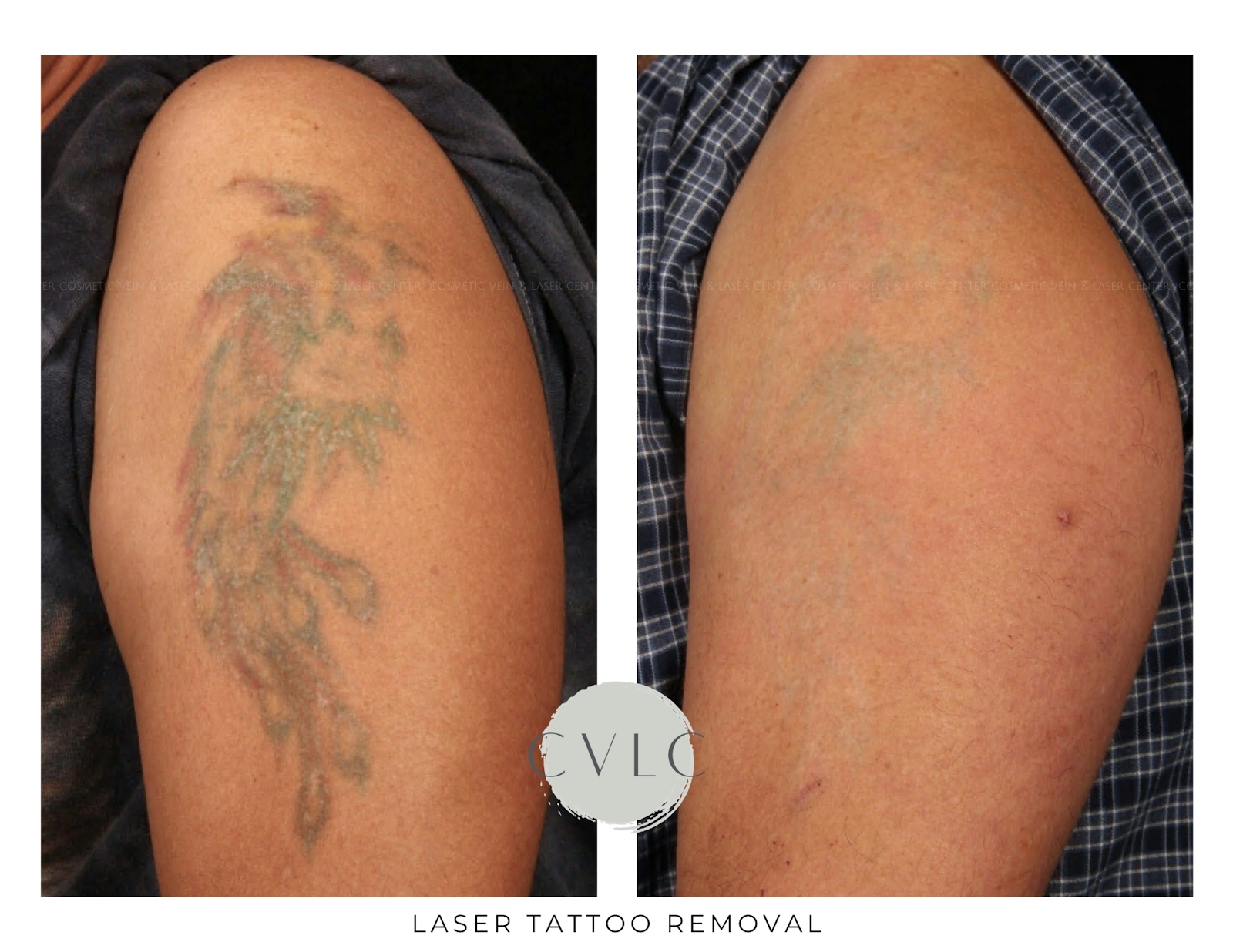Laser Tattoo Removal Before & After Gallery - Patient 107319 - Image 1