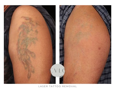 Laser Tattoo Removal Before & After Gallery - Patient 107319 - Image 1