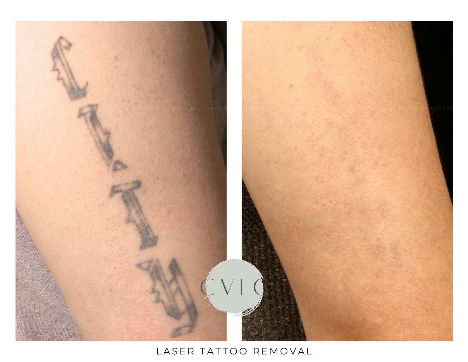 Laser Tattoo Removal Before & After Gallery - Patient 134174 - Image 1