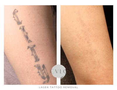 Laser Tattoo Removal Before & After Gallery - Patient 134174 - Image 1