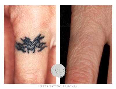 Laser Tattoo Removal Before & After Gallery - Patient 163219 - Image 1