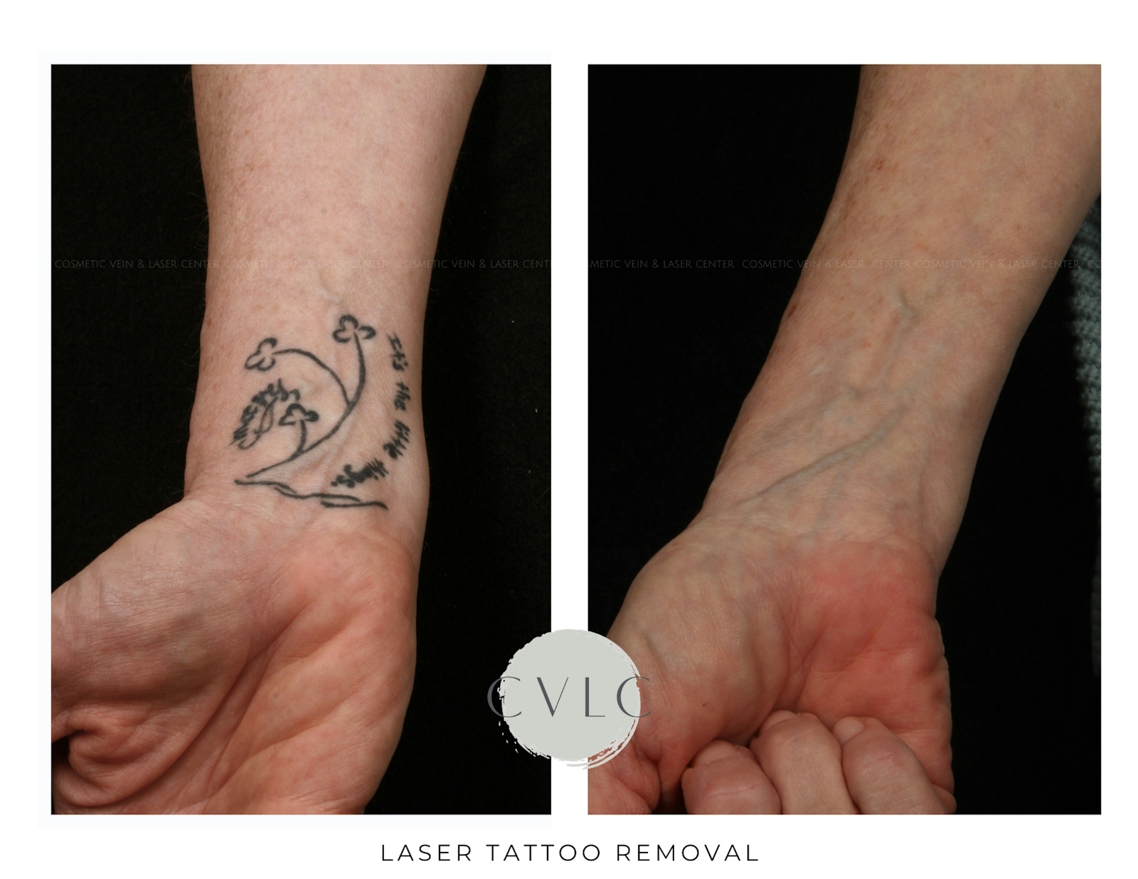 Laser Tattoo Removal Before & After Gallery - Patient 352002 - Image 1