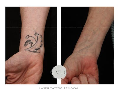 Laser Tattoo Removal Before & After Gallery - Patient 352002 - Image 1