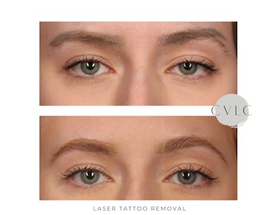 Laser Tattoo Removal Before & After Gallery - Patient 264746 - Image 1