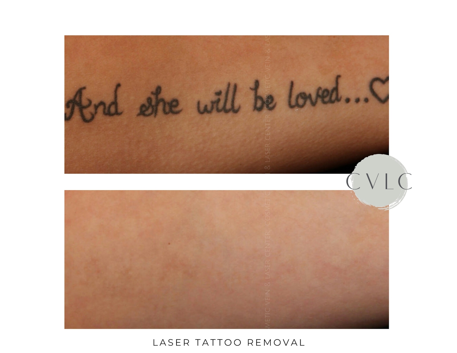Laser Tattoo Removal Before & After Gallery - Patient 259593 - Image 1