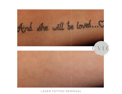 Laser Tattoo Removal Before & After Gallery - Patient 259593 - Image 1