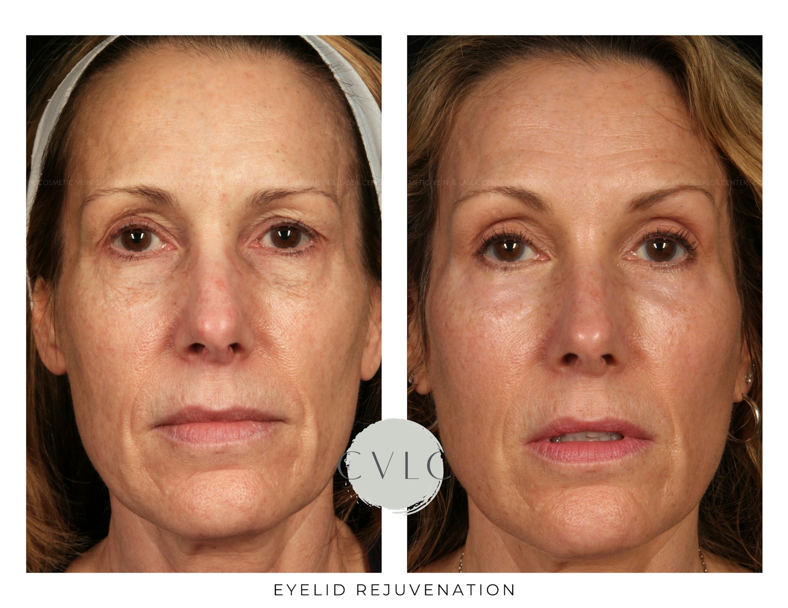 Eyelid Rejuvenation Before & After Gallery - Patient 421498 - Image 1