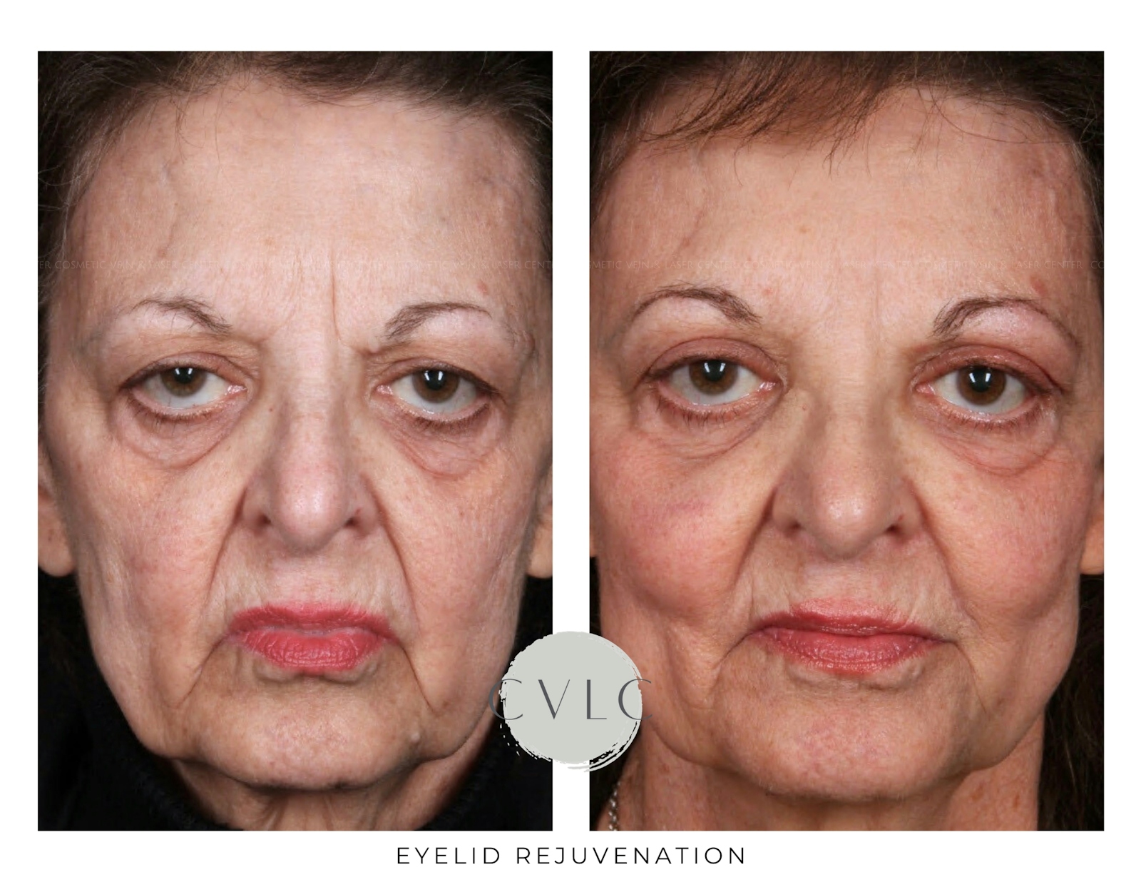 Eyelid Rejuvenation Before & After Gallery - Patient 276145 - Image 1