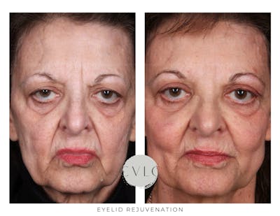Eyelid Rejuvenation Before & After Gallery - Patient 276145 - Image 1