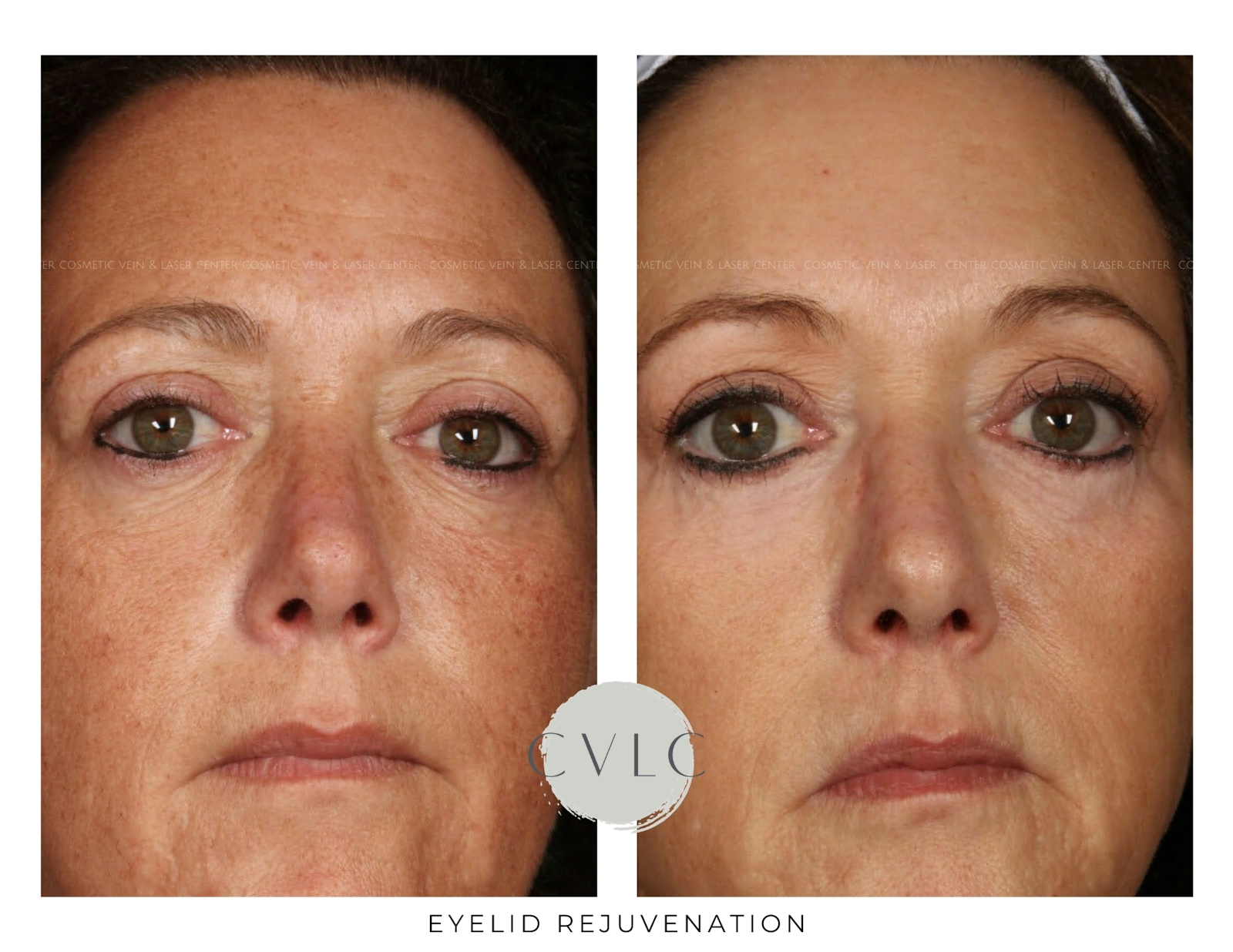 Eyelid Rejuvenation Before & After Gallery - Patient 143616 - Image 1