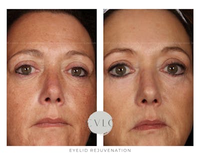 Eyelid Rejuvenation Before & After Gallery - Patient 143616 - Image 1