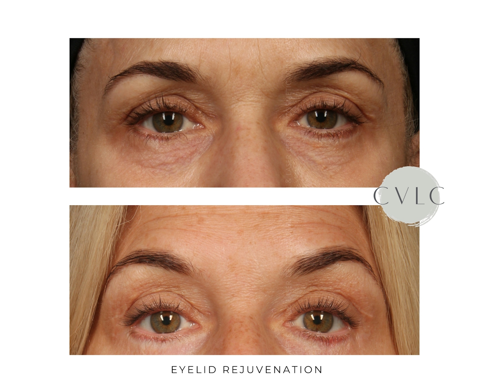 Eyelid Rejuvenation Before & After Gallery - Patient 694762 - Image 1