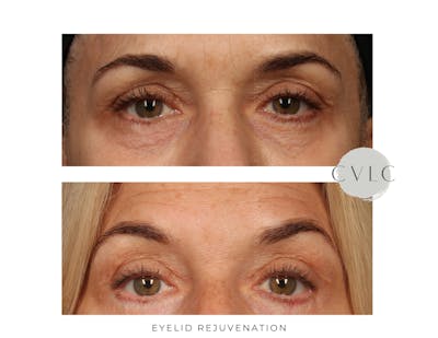 Eyelid Rejuvenation Before & After Gallery - Patient 694762 - Image 1