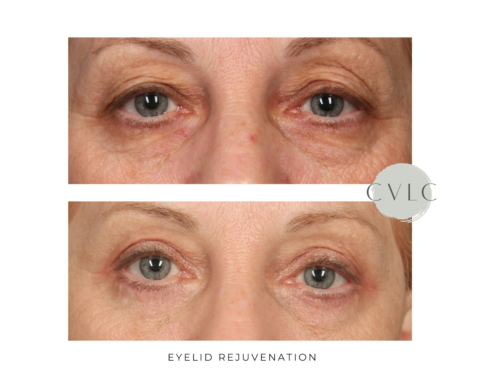 Eyelid Rejuvenation Before & After Gallery - Patient 197753 - Image 1