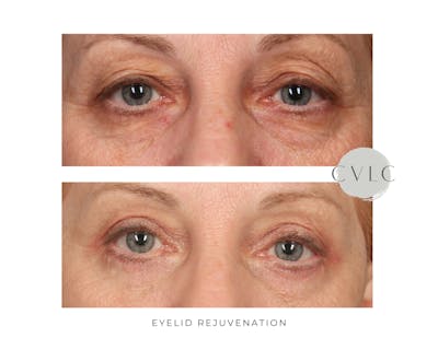 Eyelid Rejuvenation Before & After Gallery - Patient 197753 - Image 1
