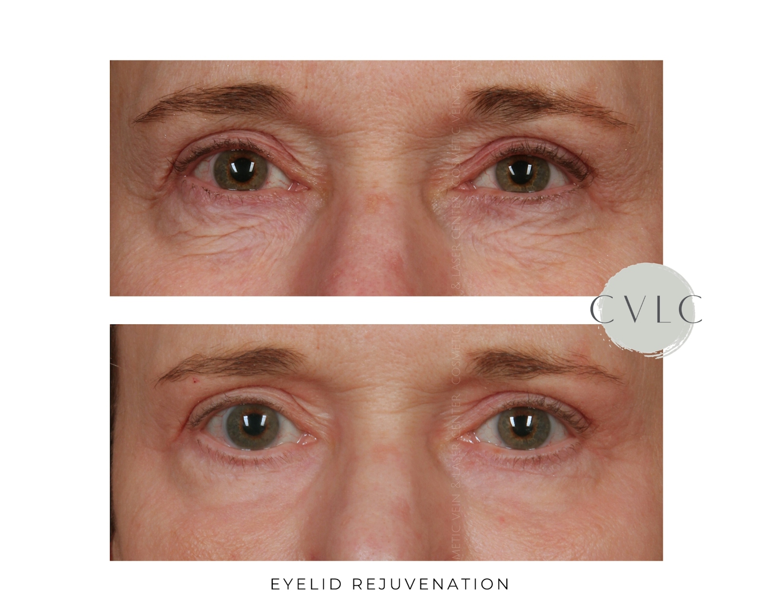 Eyelid Rejuvenation Before & After Gallery - Patient 164722 - Image 1