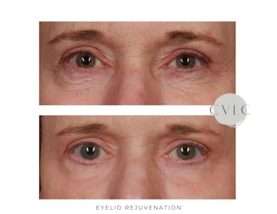 Eyelid Rejuvenation Before & After Gallery - Patient 164722 - Image 1