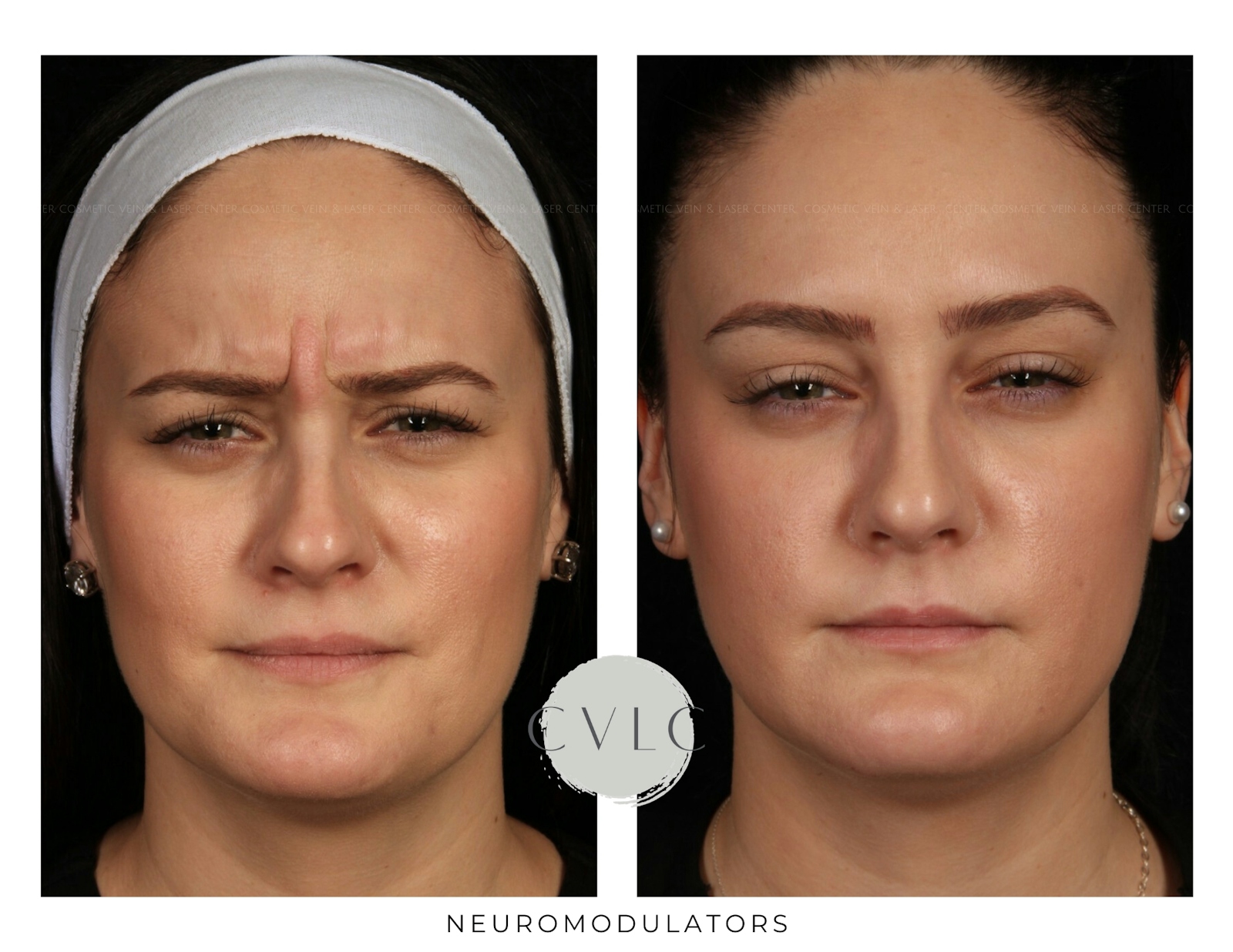 Neuromodulators Before & After Gallery - Patient 554660 - Image 1