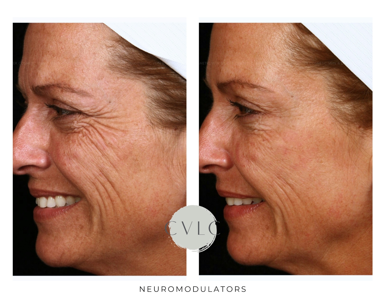 Neuromodulators Before & After Gallery - Patient 355537 - Image 1