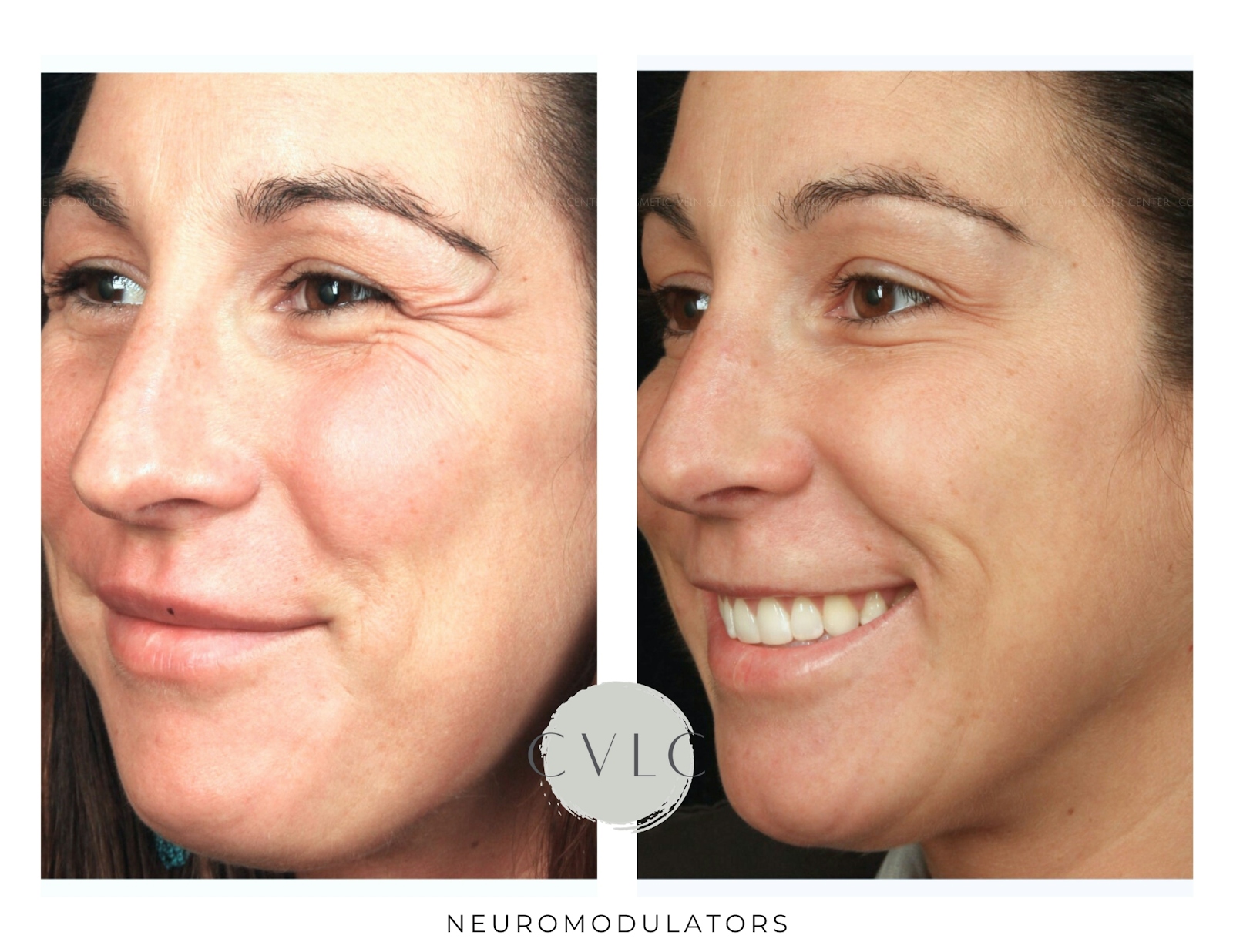 Neuromodulators Before & After Gallery - Patient 241123 - Image 1