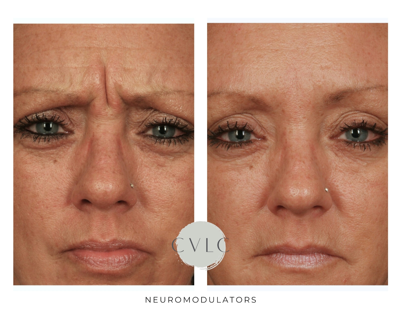 Neuromodulators Before & After Gallery - Patient 384682 - Image 1
