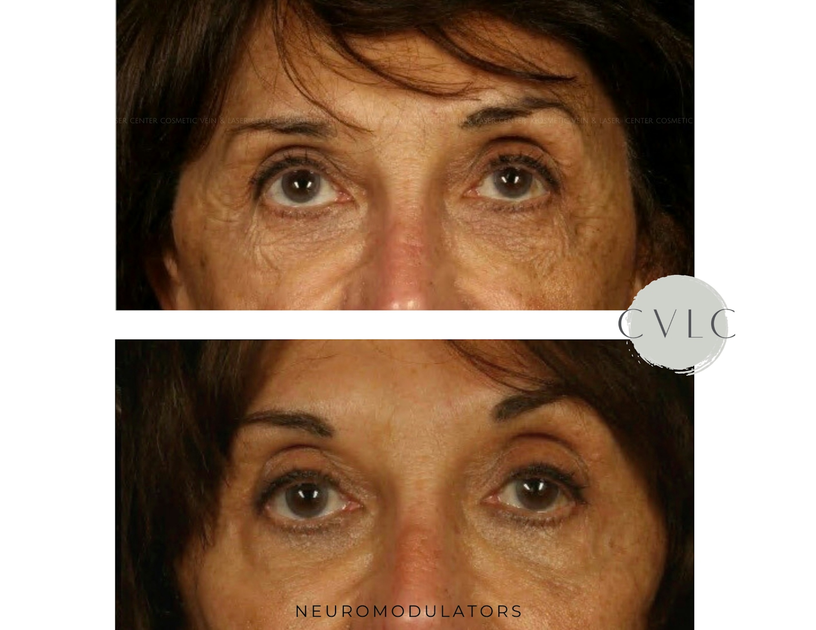 Neuromodulators Before & After Gallery - Patient 426233 - Image 1