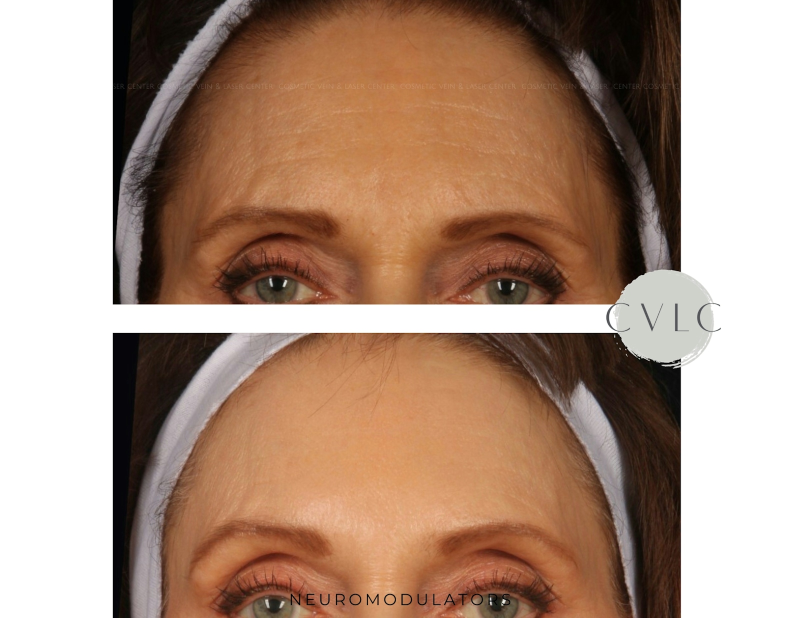 Neuromodulators Before & After Gallery - Patient 364447 - Image 1