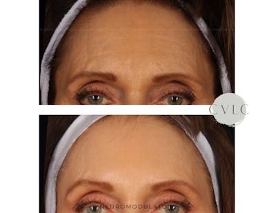 Neuromodulators Before & After Gallery - Patient 364447 - Image 1