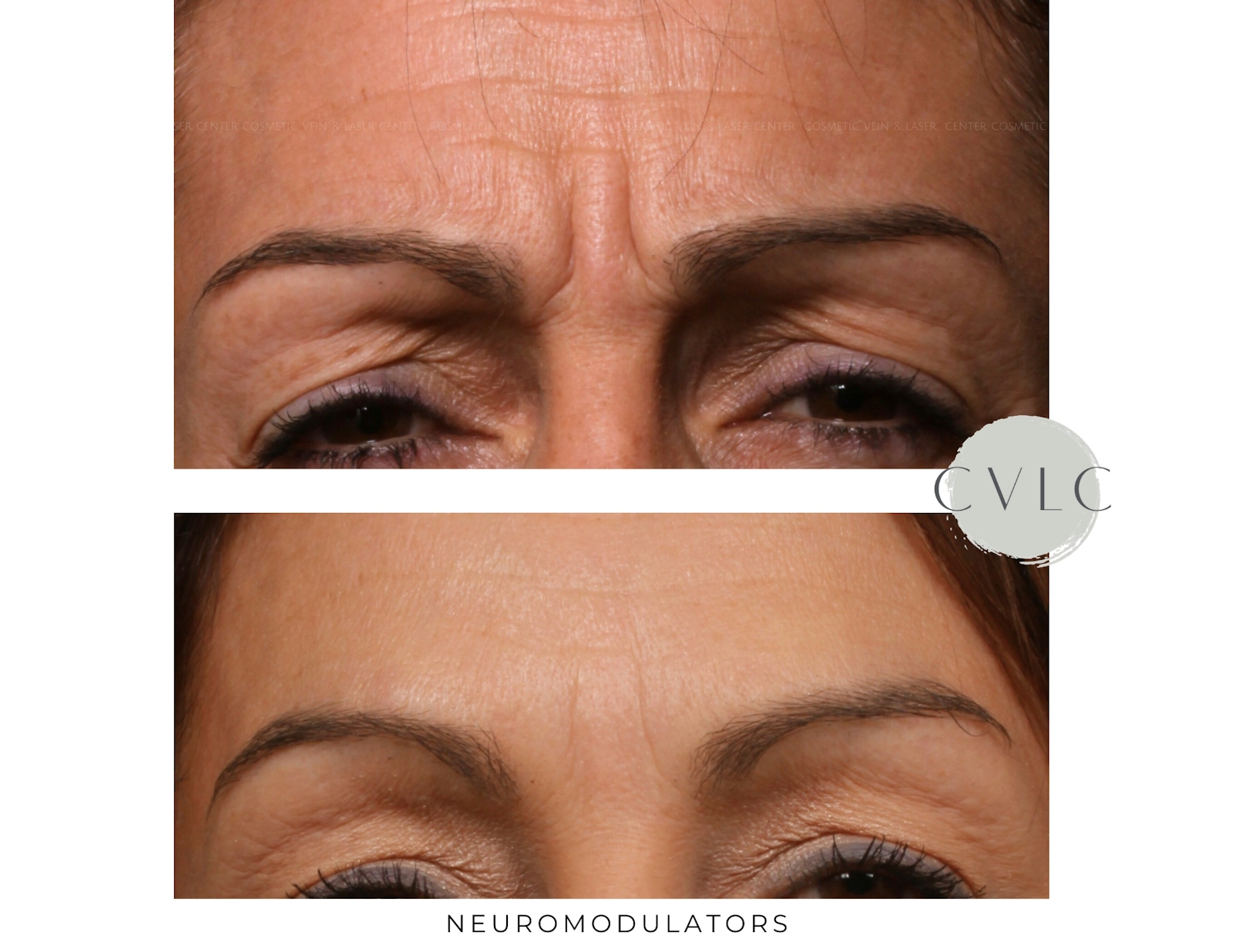 Neuromodulators Before & After Gallery - Patient 351475 - Image 1