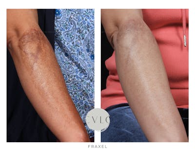 Fraxel Re:store™ Laser Rejuvenation Before & After Gallery - Patient 249156 - Image 1