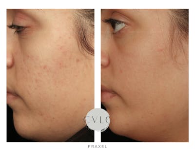 Fraxel Re:store™ Laser Rejuvenation Before & After Gallery - Patient 417988 - Image 1