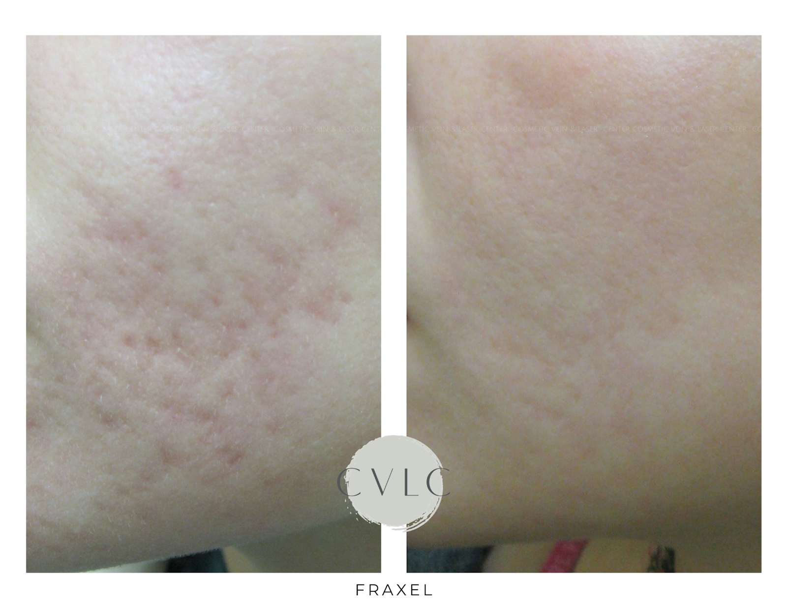 Fraxel Re:store™ Laser Rejuvenation Before & After Gallery - Patient 407913 - Image 1