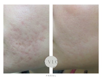 Fraxel Re:store™ Laser Rejuvenation Before & After Gallery - Patient 407913 - Image 1