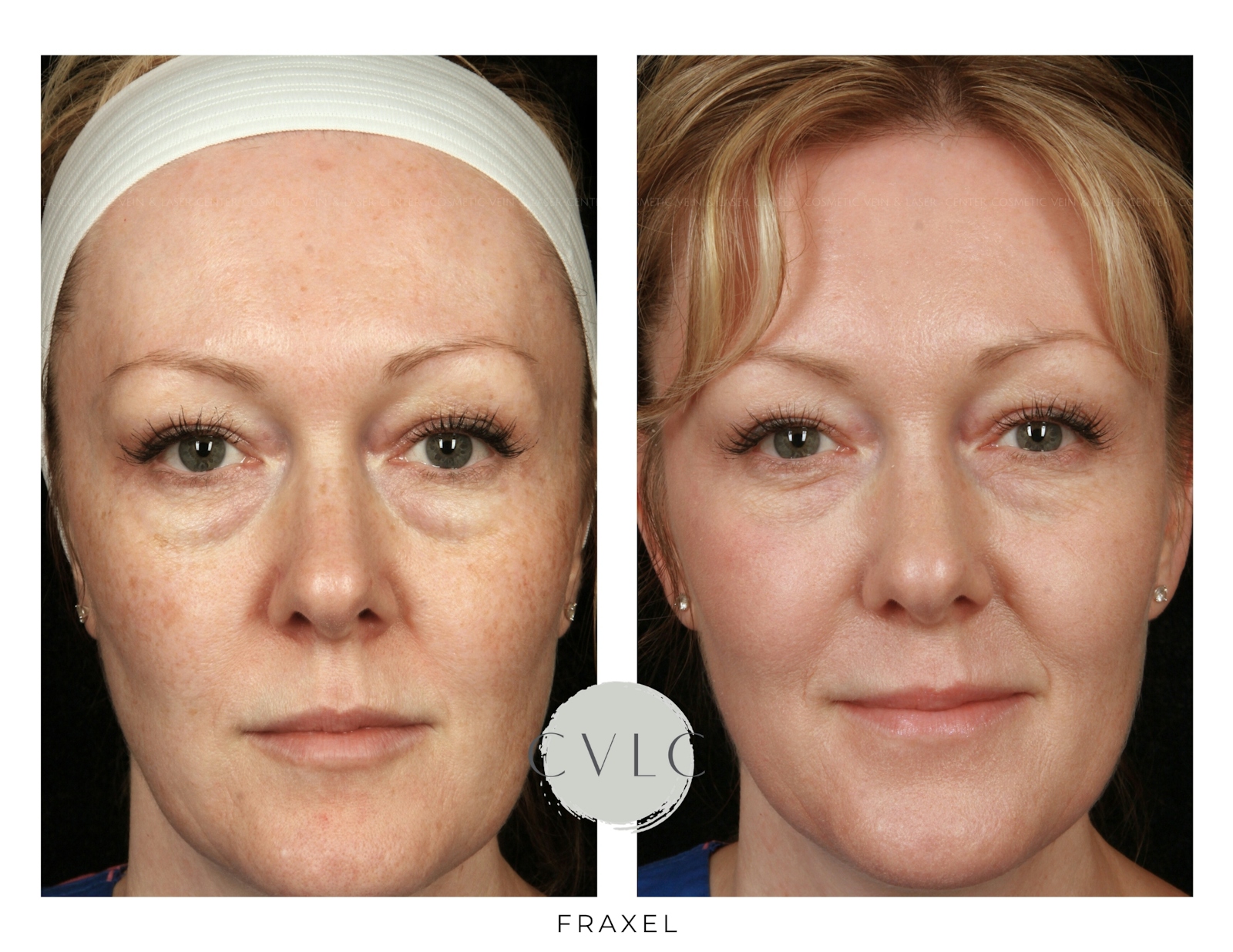 Fraxel Re:store™ Laser Rejuvenation Before & After Gallery - Patient 322048 - Image 1