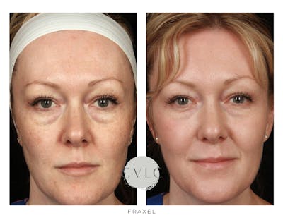 Fraxel Re:store™ Laser Rejuvenation Before & After Gallery - Patient 322048 - Image 1