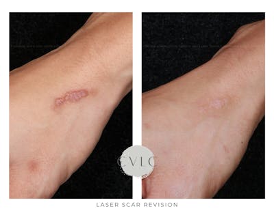 Laser Scar Treatments Before & After Gallery - Patient 177586 - Image 1