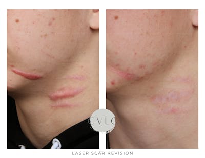 Laser Scar Treatments Before & After Gallery - Patient 210513 - Image 1