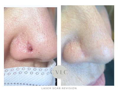 Laser Scar Treatments Before & After Gallery - Patient 392585 - Image 1