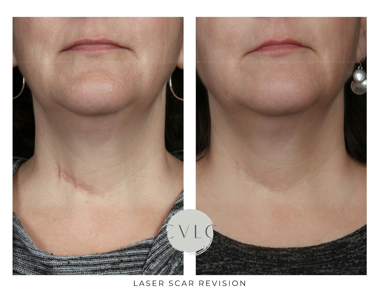 Laser Scar Treatments Before & After Gallery - Patient 311382 - Image 1
