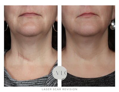Laser Scar Treatments Before & After Gallery - Patient 311382 - Image 1