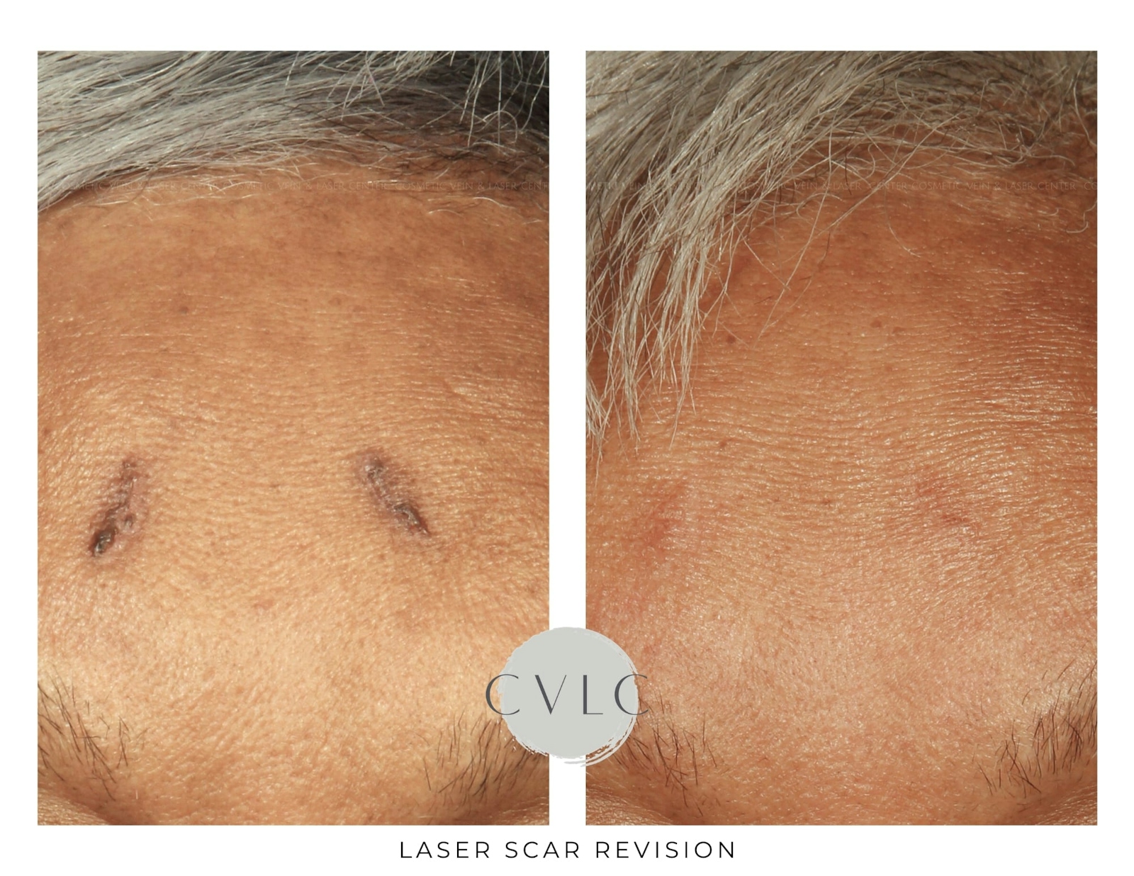 Laser Scar Treatments Before & After Gallery - Patient 149671 - Image 1